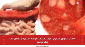 التهاب القولون التقرحي: كيف تكتشف أعراضه المبكرة وتتعامل معه قبل تفاقمه